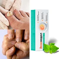 Экзинидол — защитит от грибка ногтей и микоза.
