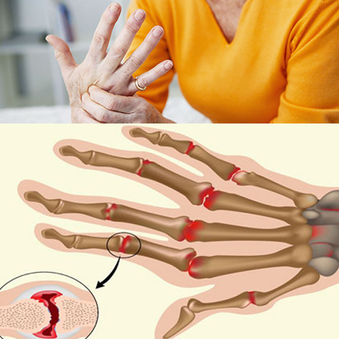 Ревматоидный артрит лечение у женщин после 60 средством Артрозакс.
