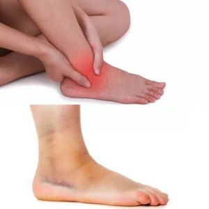 лечение артрита суставов стопы ног